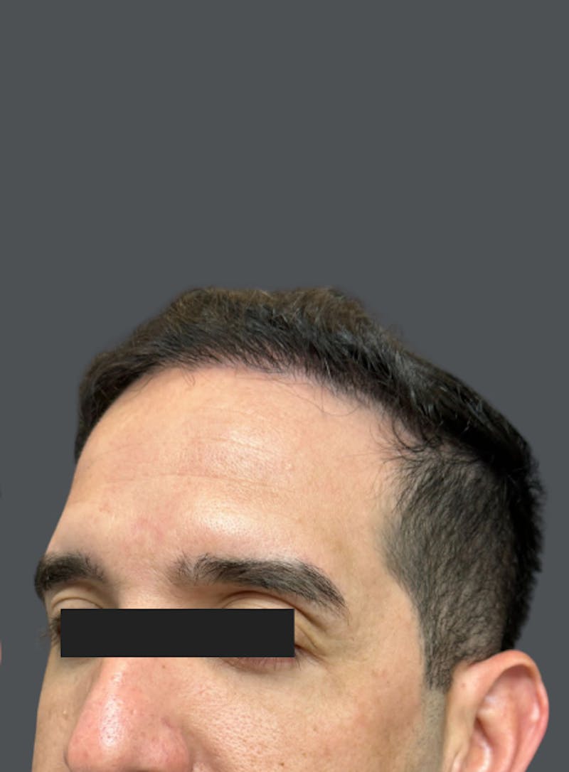 Hair Transplant Before & After Gallery - Patient 226333 - Image 2