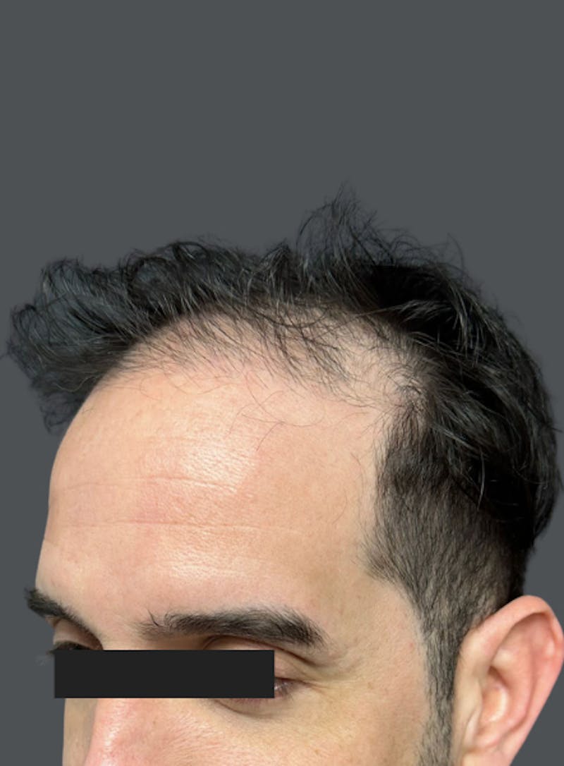 Hair Transplant Before & After Gallery - Patient 226333 - Image 1