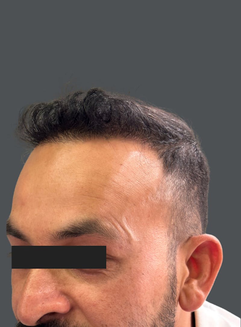Hair Transplant Before & After Gallery - Patient 763273 - Image 2