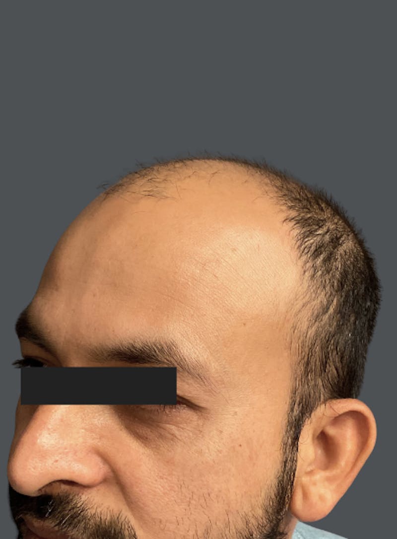 Hair Transplant Before & After Gallery - Patient 763273 - Image 1