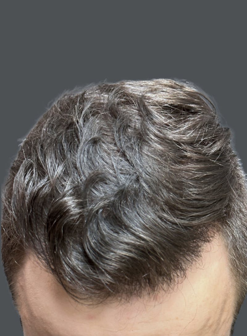 Hair Transplant Before & After Gallery - Patient 285219 - Image 2