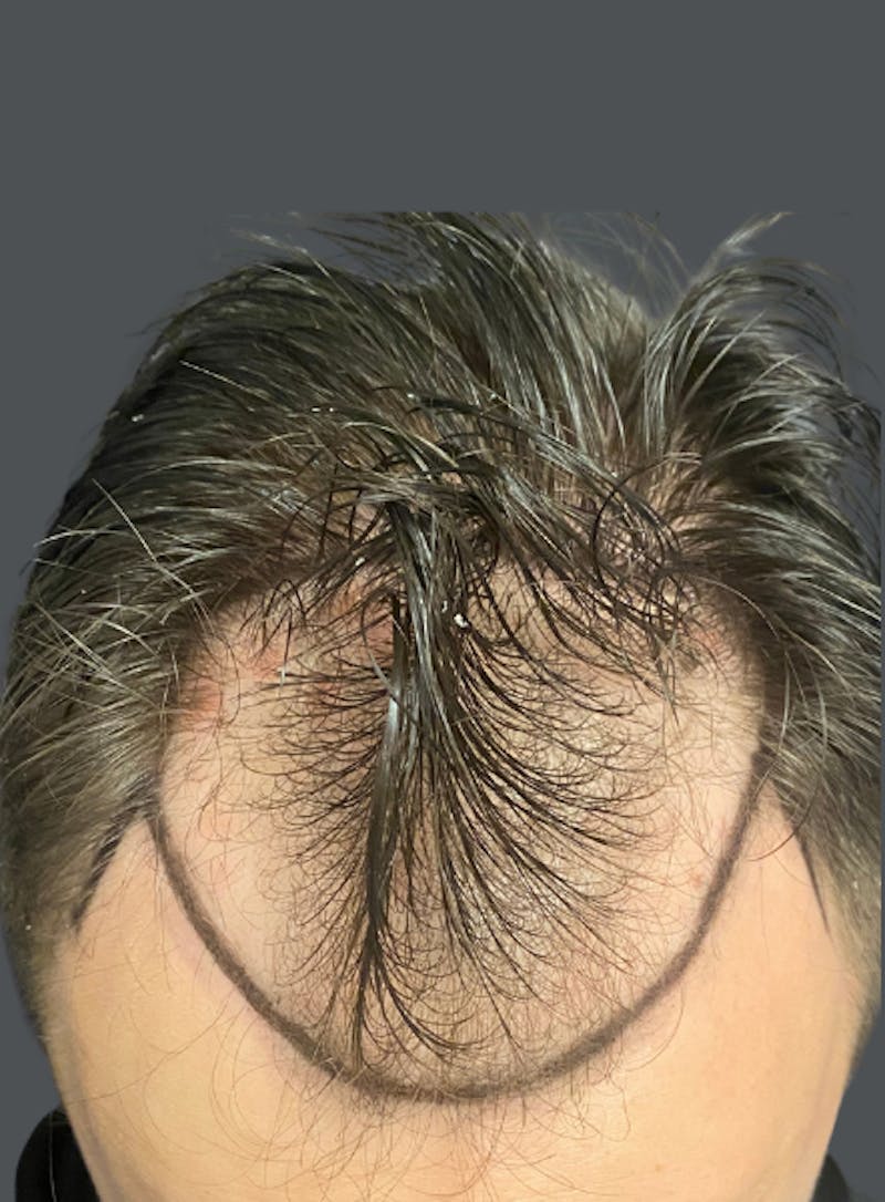 Hair Transplant Before & After Gallery - Patient 285219 - Image 1