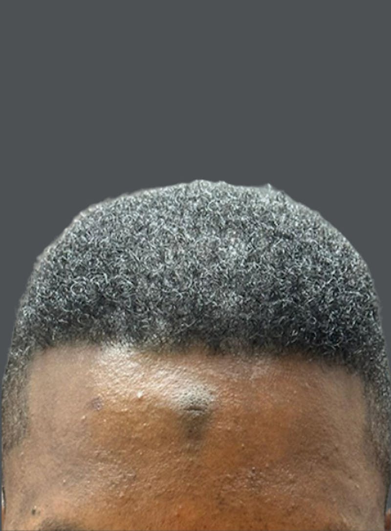 Hair Transplant Before & After Gallery - Patient 311293 - Image 2