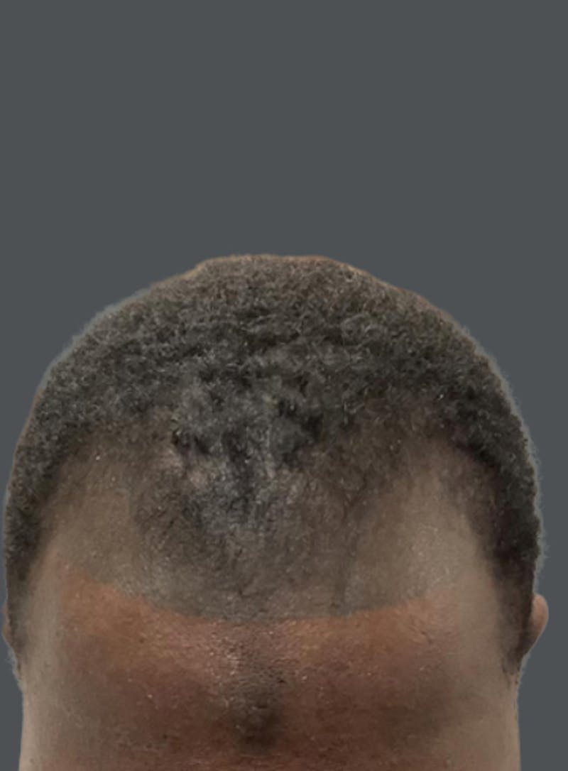 Hair Transplant Before & After Gallery - Patient 311293 - Image 1