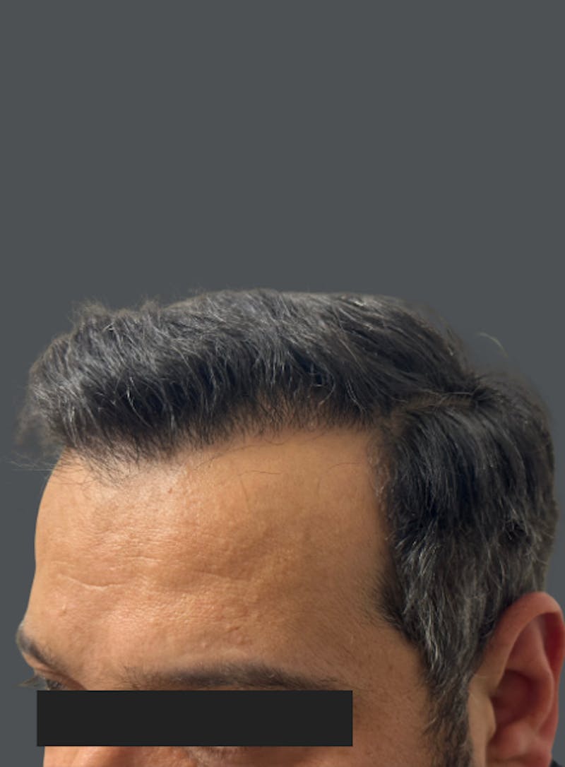 Hair Transplant Before & After Gallery - Patient 347527 - Image 2