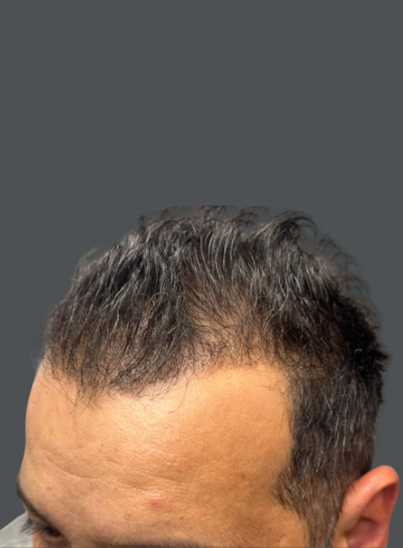 Hair Transplant Before & After Gallery - Patient 347527 - Image 1