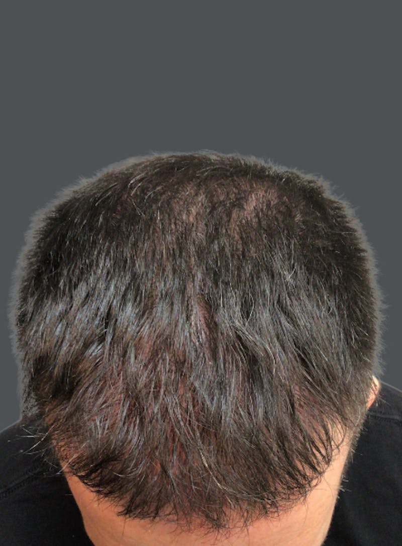 Hair Transplant Before & After Gallery - Patient 242410 - Image 2