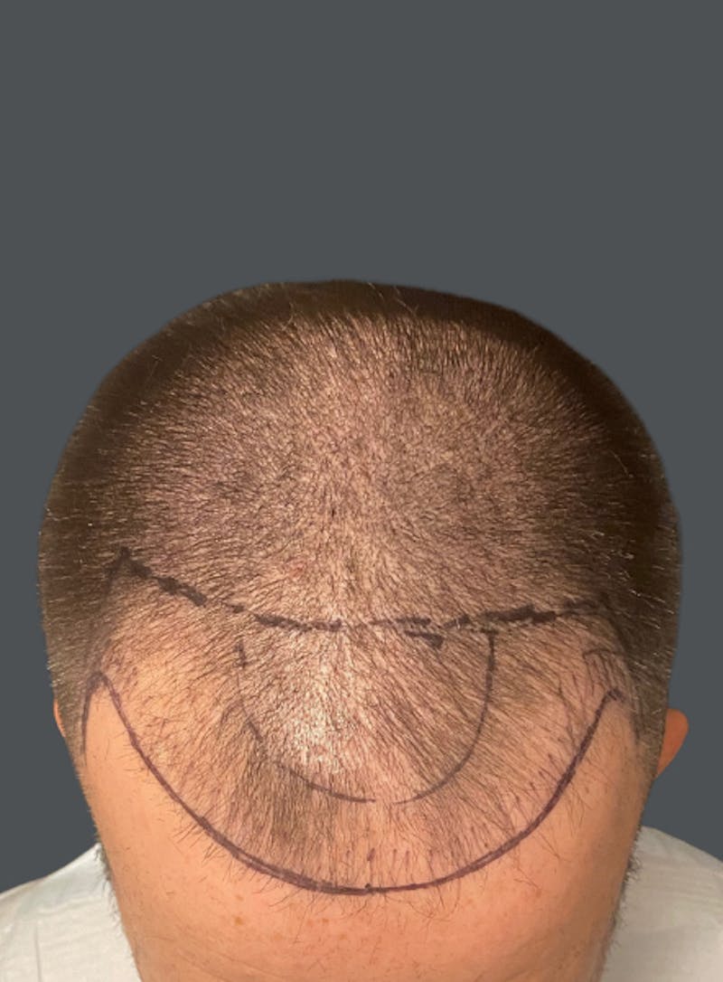 Hair Transplant Before & After Gallery - Patient 242410 - Image 1