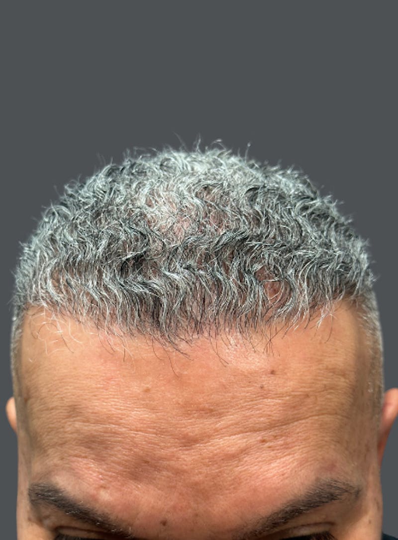 Hair Transplant Before & After Gallery - Patient 326078 - Image 2