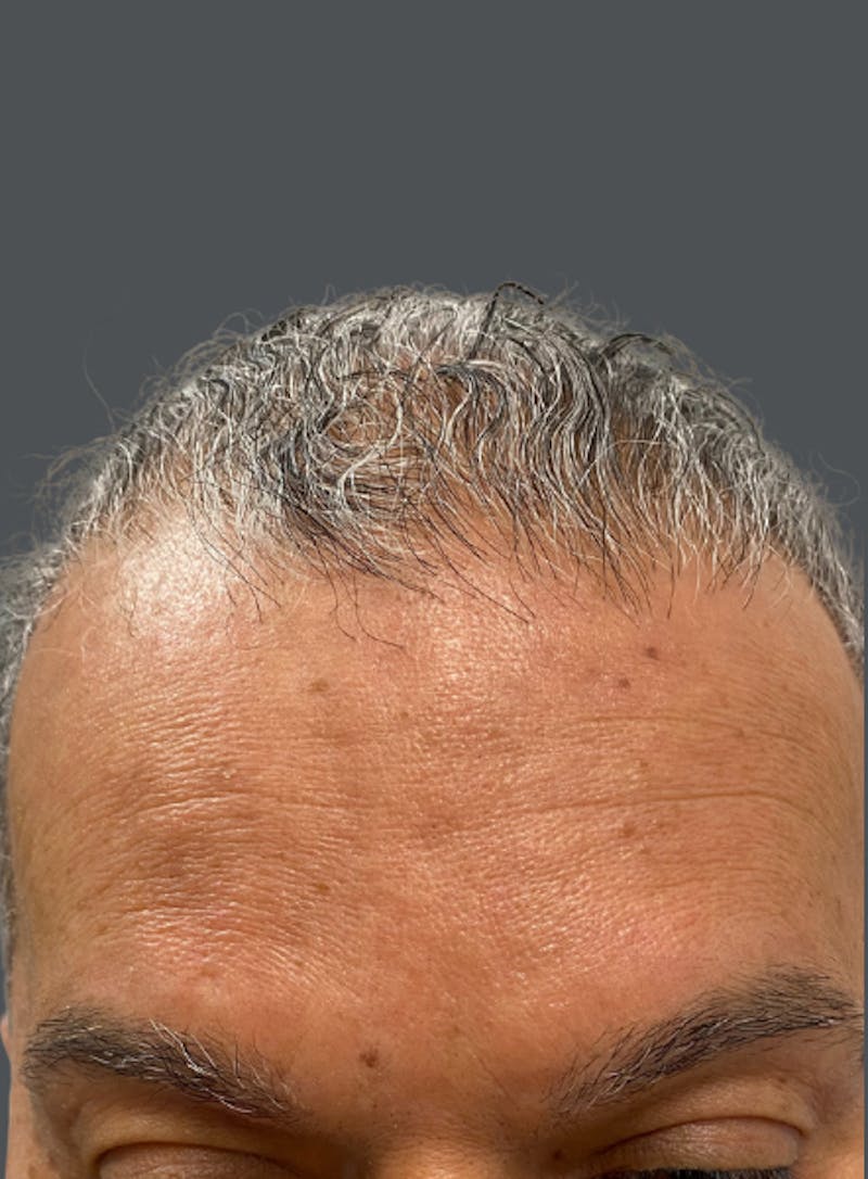 Hair Transplant Before & After Gallery - Patient 326078 - Image 1