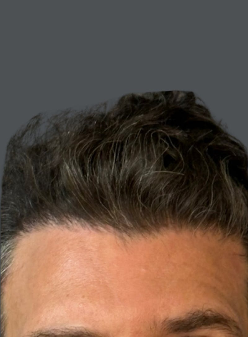 Hair Transplant Before & After Gallery - Patient 374652 - Image 2