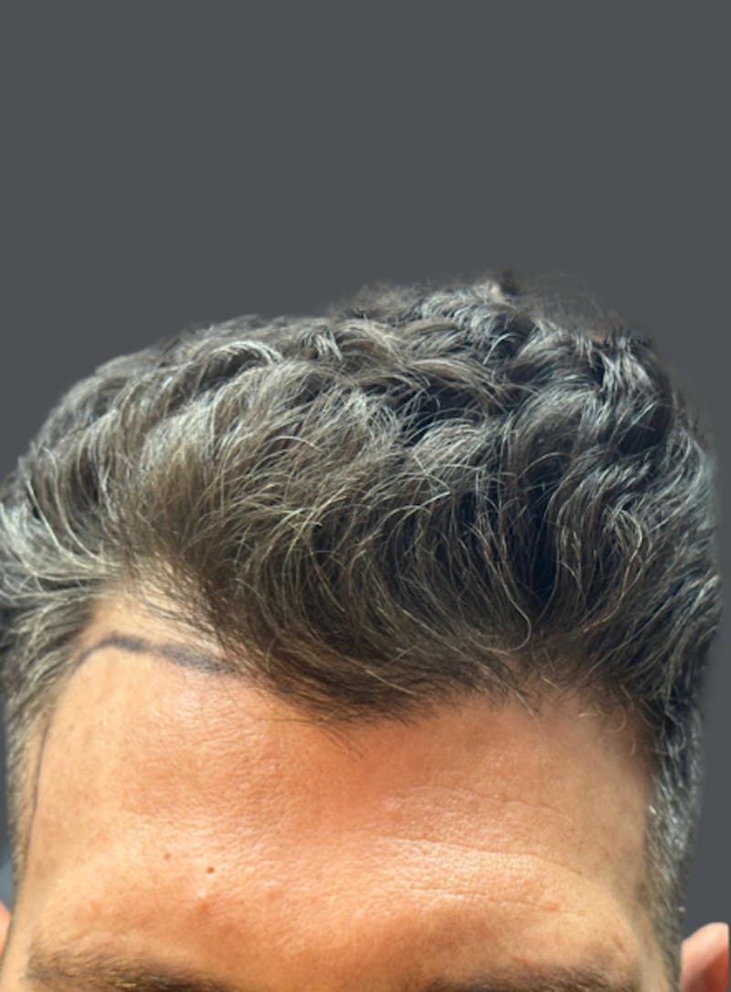 Hair Transplant Before & After Gallery - Patient 374652 - Image 1