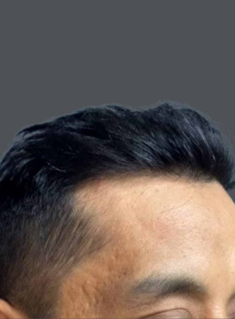 Hair Transplant Before & After Gallery - Patient 191843 - Image 2