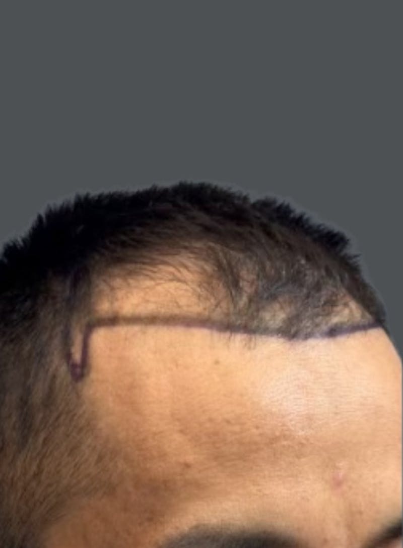 Hair Transplant Before & After Gallery - Patient 191843 - Image 1