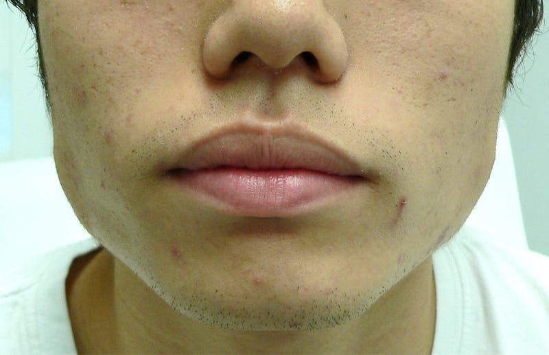 Botox for TMJ / Jaw Before & After Gallery - Patient 941660 - Image 1