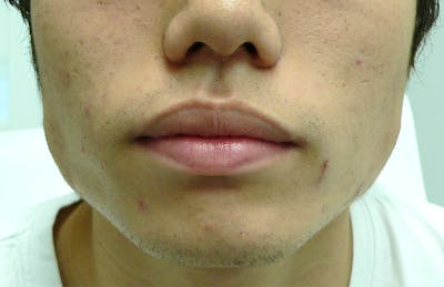Botox for TMJ / Jaw Before & After Gallery - Patient 941660 - Image 1