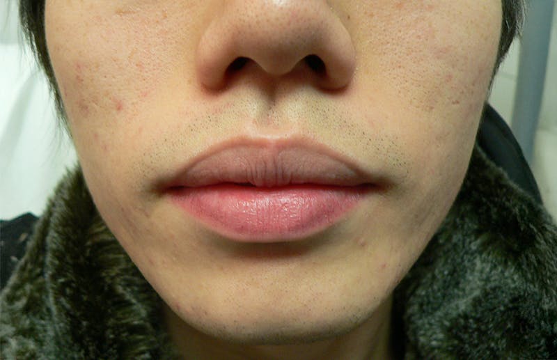 Botox for TMJ / Jaw Before & After Gallery - Patient 941660 - Image 2
