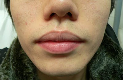 Botox for TMJ / Jaw Before & After Gallery - Patient 941660 - Image 2
