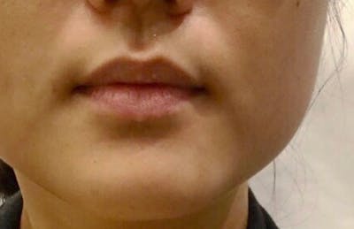 Botox for TMJ / Jaw Before & After Gallery - Patient 341450 - Image 1