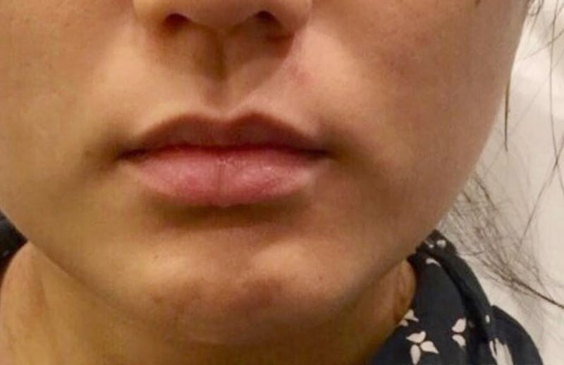 Botox for TMJ / Jaw Before & After Gallery - Patient 341450 - Image 2
