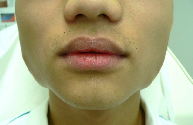 Botox for TMJ / Jaw Before & After Gallery - Patient 217902 - Image 1