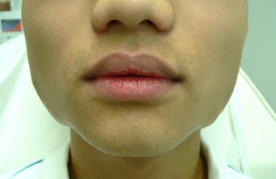 Botox for TMJ / Jaw Before & After Gallery - Patient 217902 - Image 1