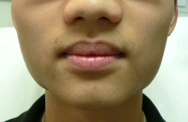 Botox for TMJ / Jaw Before & After Gallery - Patient 217902 - Image 2