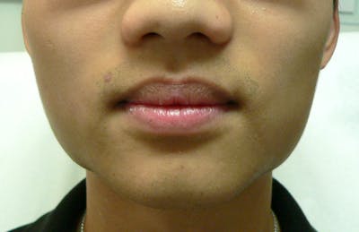 Botox for TMJ / Jaw Before & After Gallery - Patient 217902 - Image 2