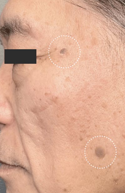 Moles, Warts, Skin Tags Before & After Gallery - Patient 112052 - Image 1