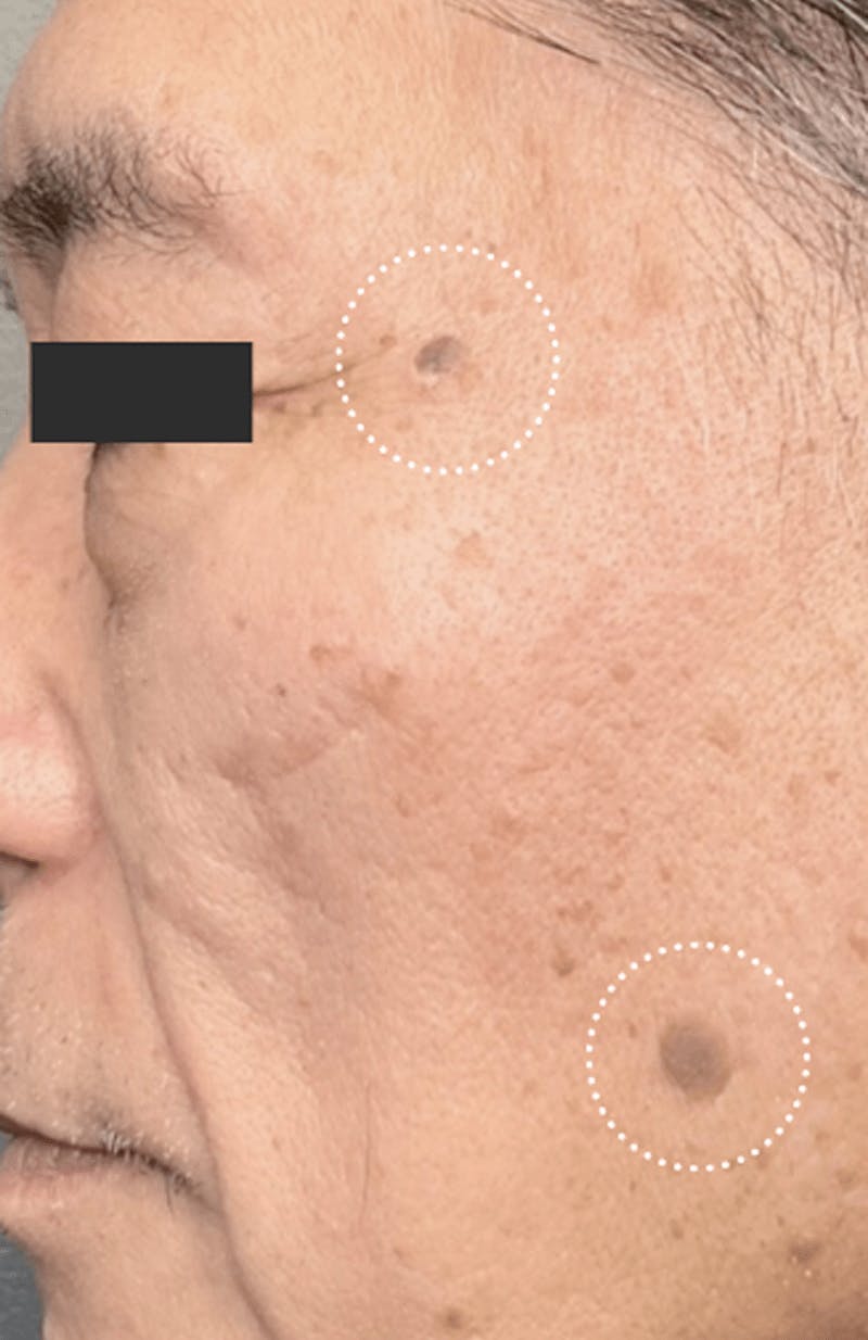 Moles, Warts, Skin Tags Before & After Gallery - Patient 112052 - Image 1