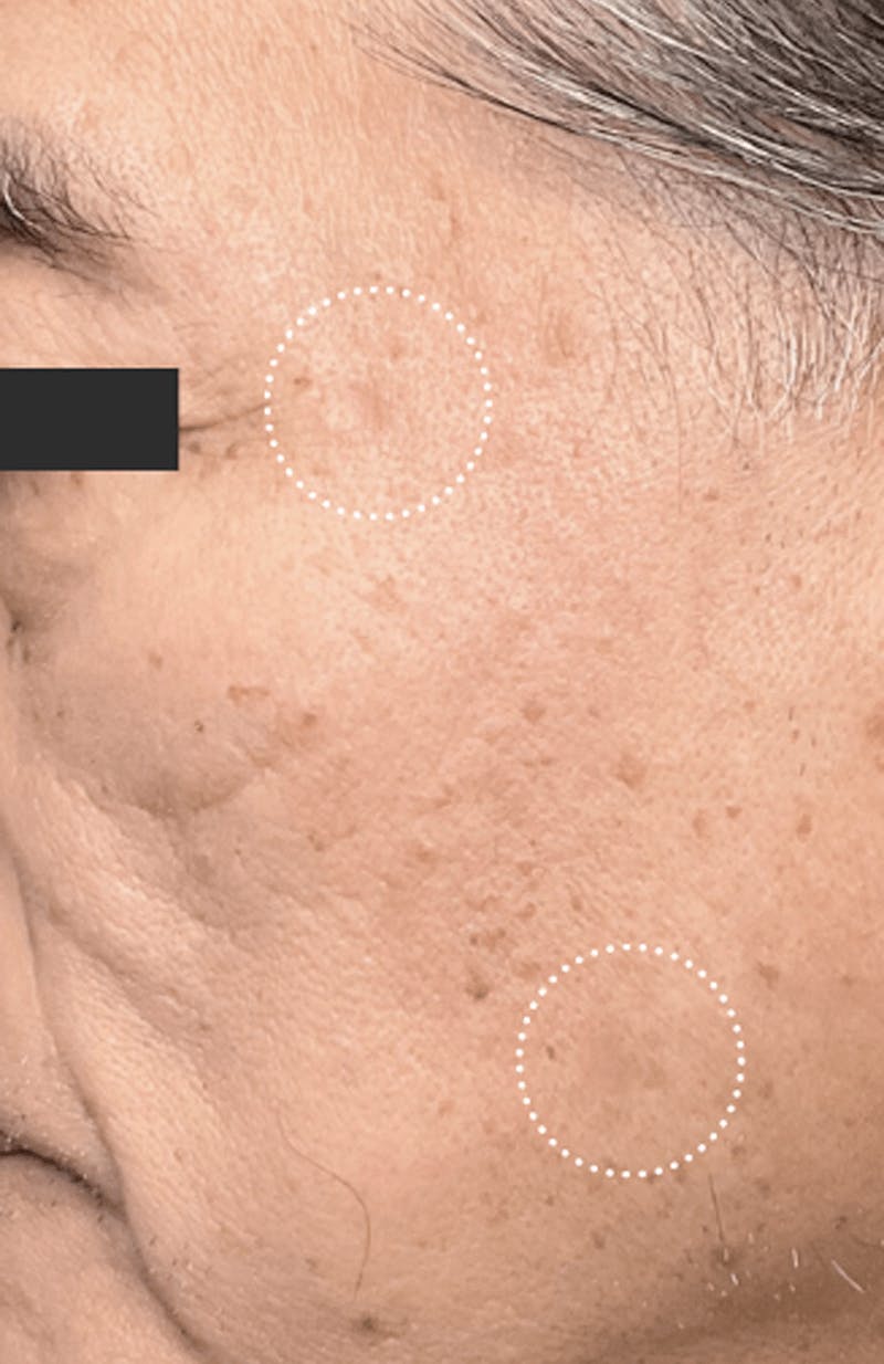 Moles, Warts, Skin Tags Before & After Gallery - Patient 112052 - Image 2