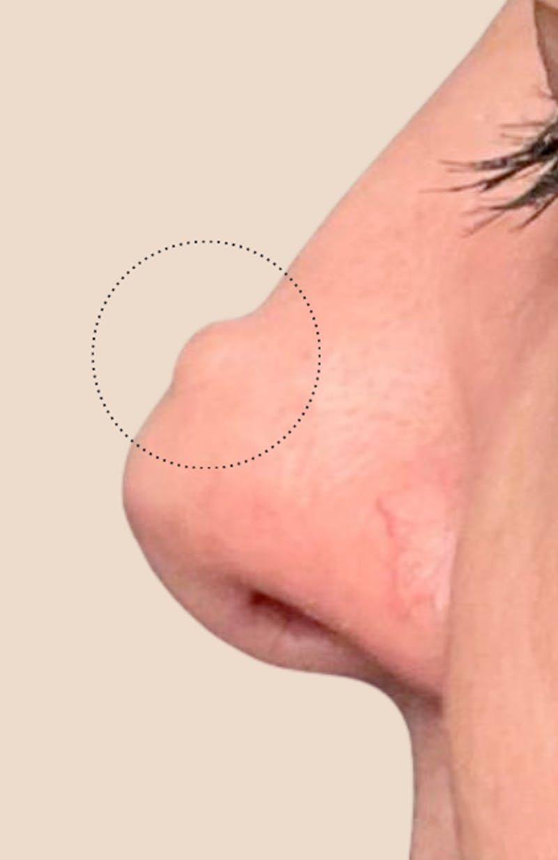 Moles, Warts, Skin Tags Before & After Gallery - Patient 380058 - Image 1