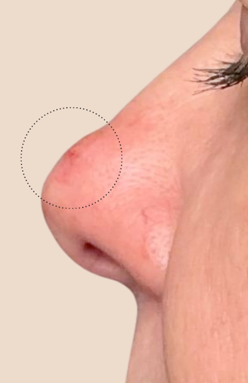 Moles, Warts, Skin Tags Before & After Gallery - Patient 380058 - Image 2