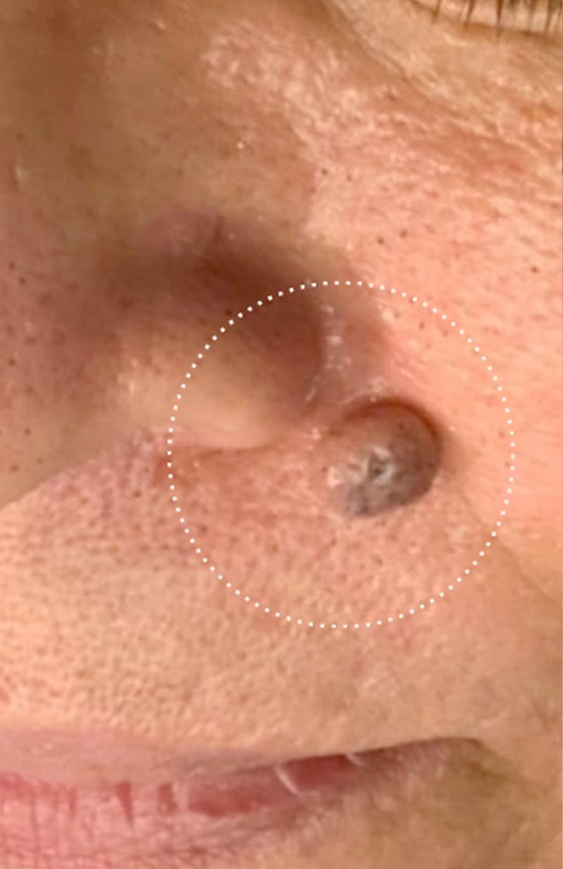 Moles, Warts, Skin Tags Before & After Gallery - Patient 252470 - Image 1