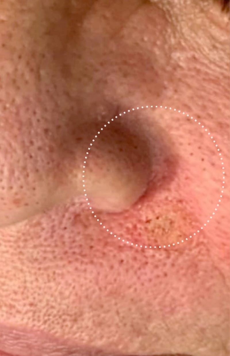 Moles, Warts, Skin Tags Before & After Gallery - Patient 252470 - Image 2