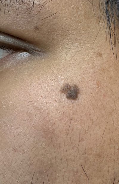 Moles, Warts, Skin Tags Before & After Gallery - Patient 370112 - Image 1