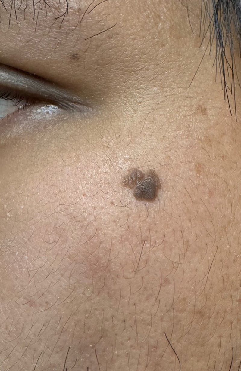 Moles, Warts, Skin Tags Before & After Gallery - Patient 370112 - Image 1