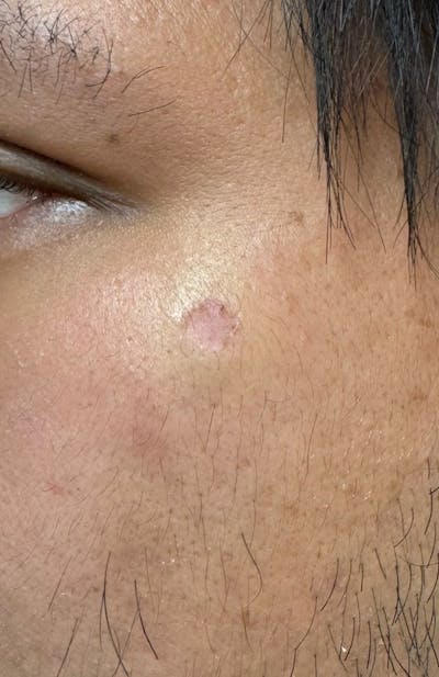 Moles, Warts, Skin Tags Before & After Gallery - Patient 370112 - Image 2