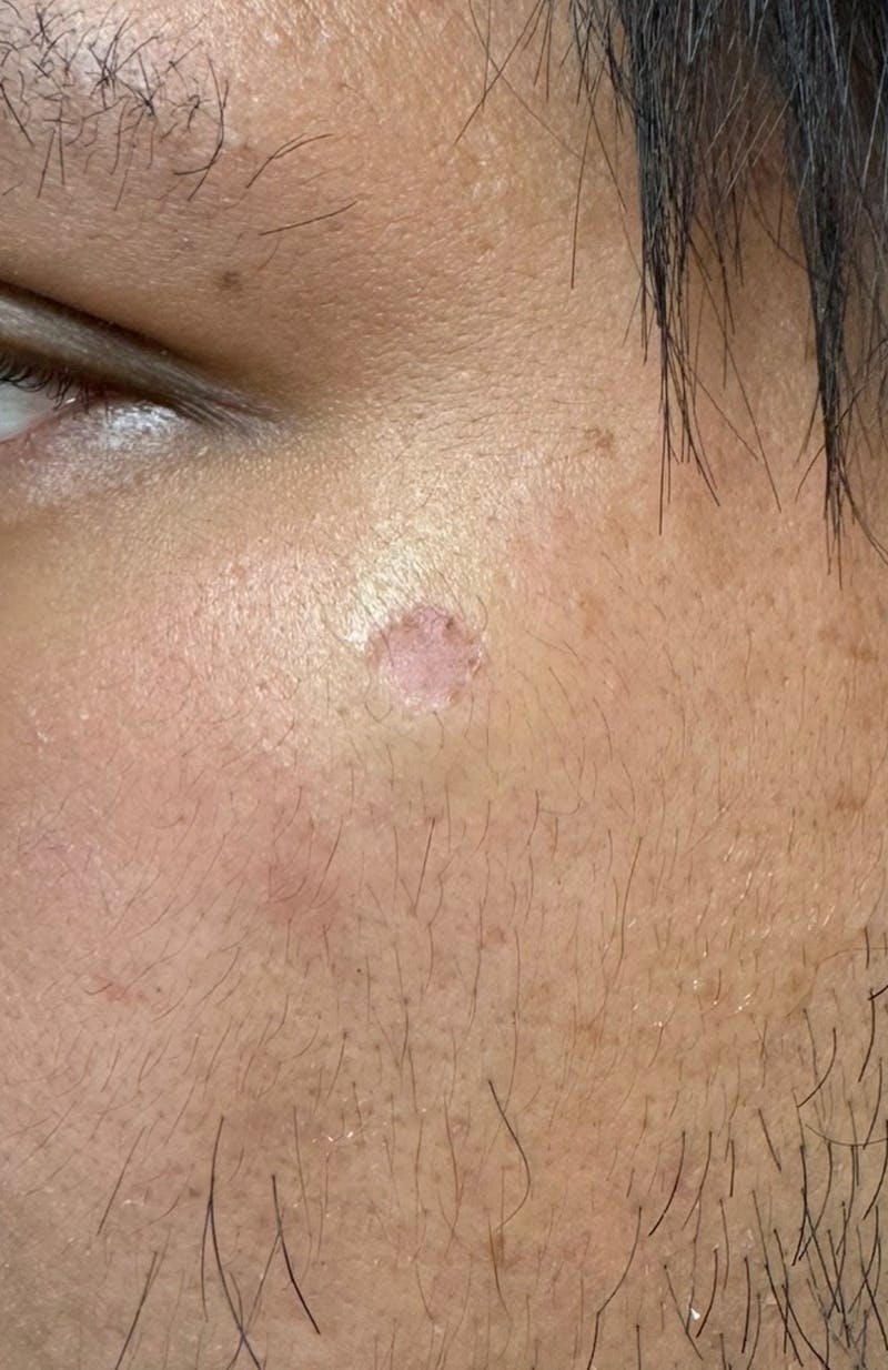 Moles, Warts, Skin Tags Before & After Gallery - Patient 370112 - Image 2