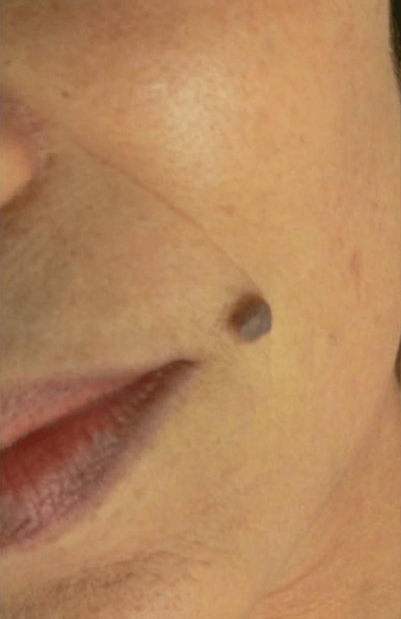 Moles, Warts, Skin Tags Before & After Gallery - Patient 257169 - Image 1