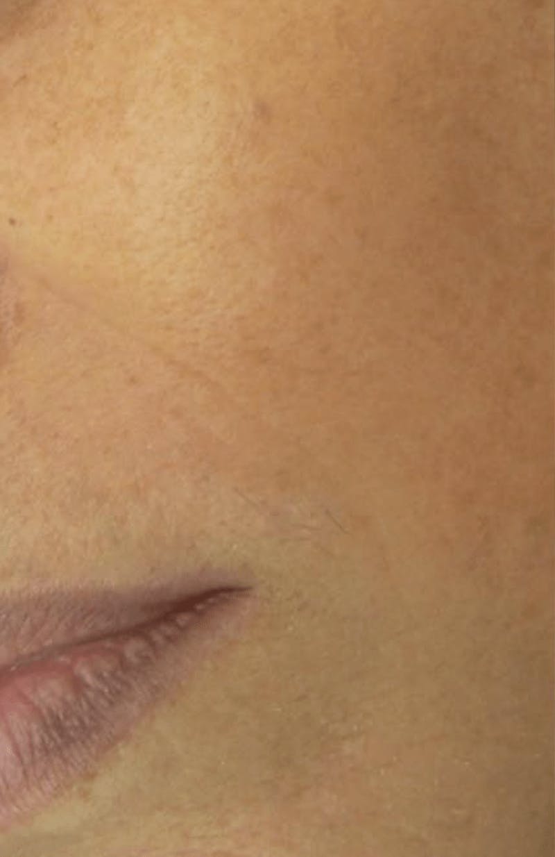 Moles, Warts, Skin Tags Before & After Gallery - Patient 257169 - Image 2