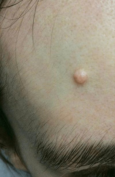 Moles, Warts, Skin Tags Before & After Gallery - Patient 302695 - Image 1
