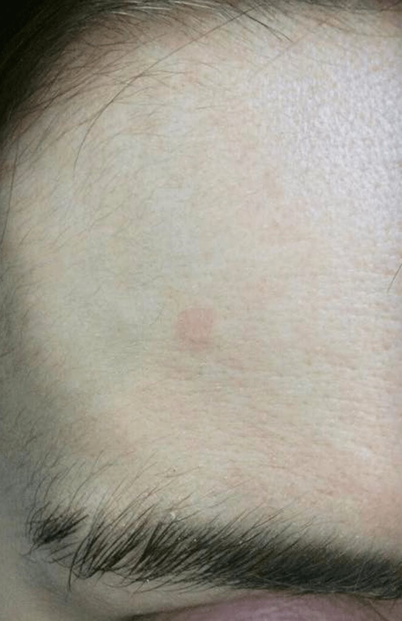 Moles, Warts, Skin Tags Before & After Gallery - Patient 302695 - Image 2