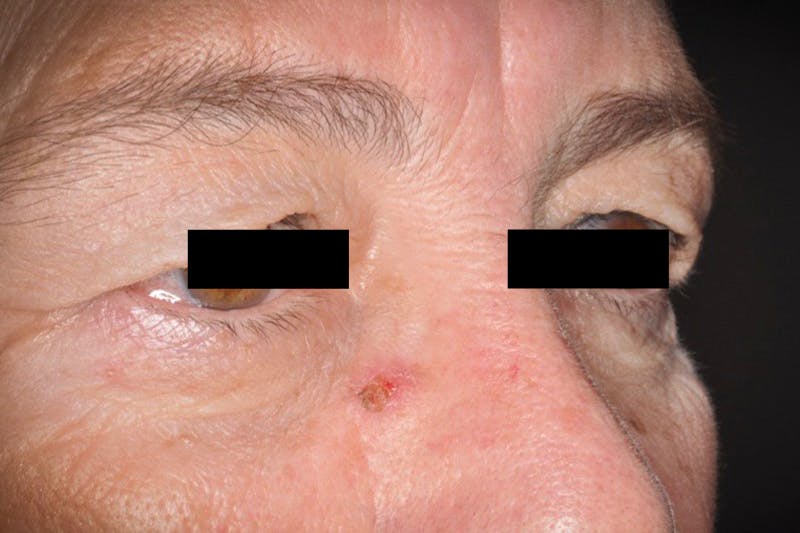 Eye Lift Before & After Gallery - Patient 339338 - Image 1