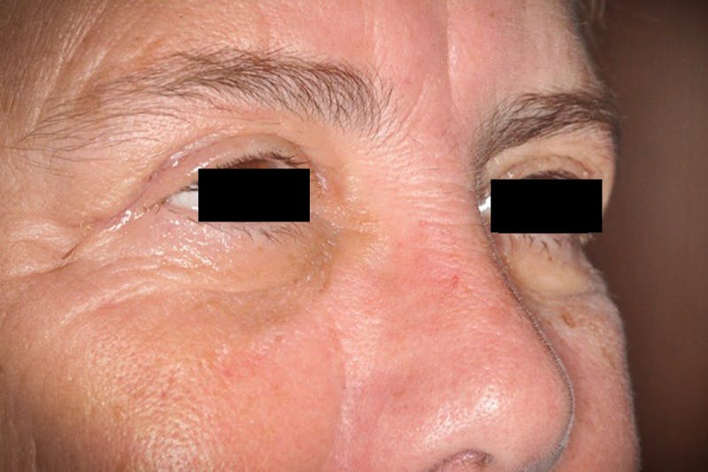 Eye Lift Before & After Gallery - Patient 339338 - Image 2