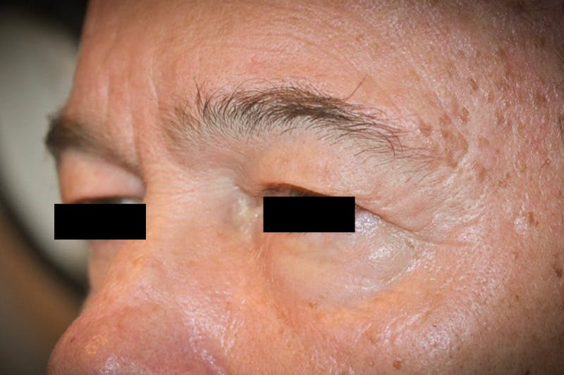 Eye Lift Before & After Gallery - Patient 302568 - Image 1