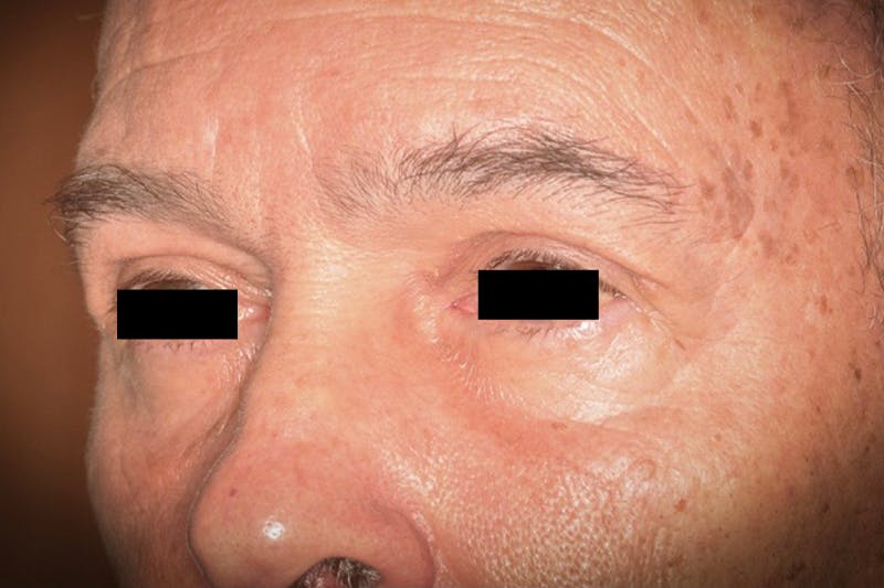 Eye Lift Before & After Gallery - Patient 302568 - Image 2