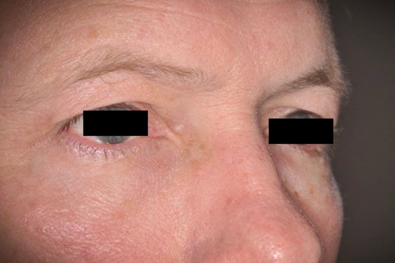 Eye Lift Before & After Gallery - Patient 708244 - Image 1