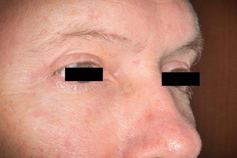 Eye Lift Before & After Gallery - Patient 708244 - Image 2