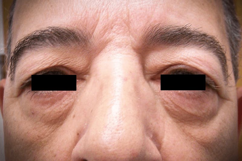 Eye Lift Before & After Gallery - Patient 171124 - Image 1